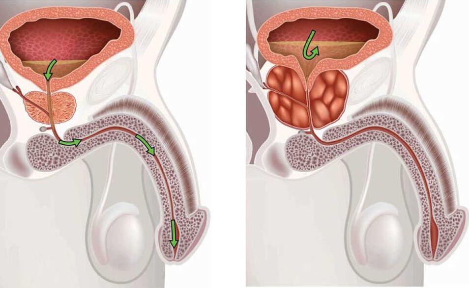 Inflammation of prostate glands
