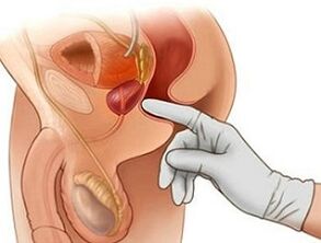 Prostate massage for the treatment of prostatitis in men